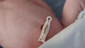 Baby mit abgeklemmter Nabelschnur