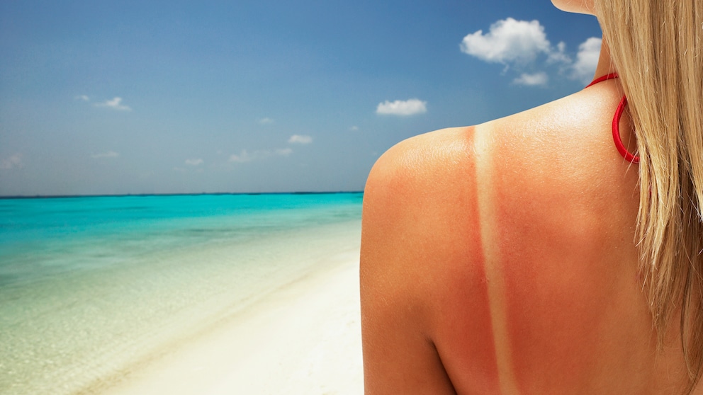 Frau mit Sonnenbrand am Strand