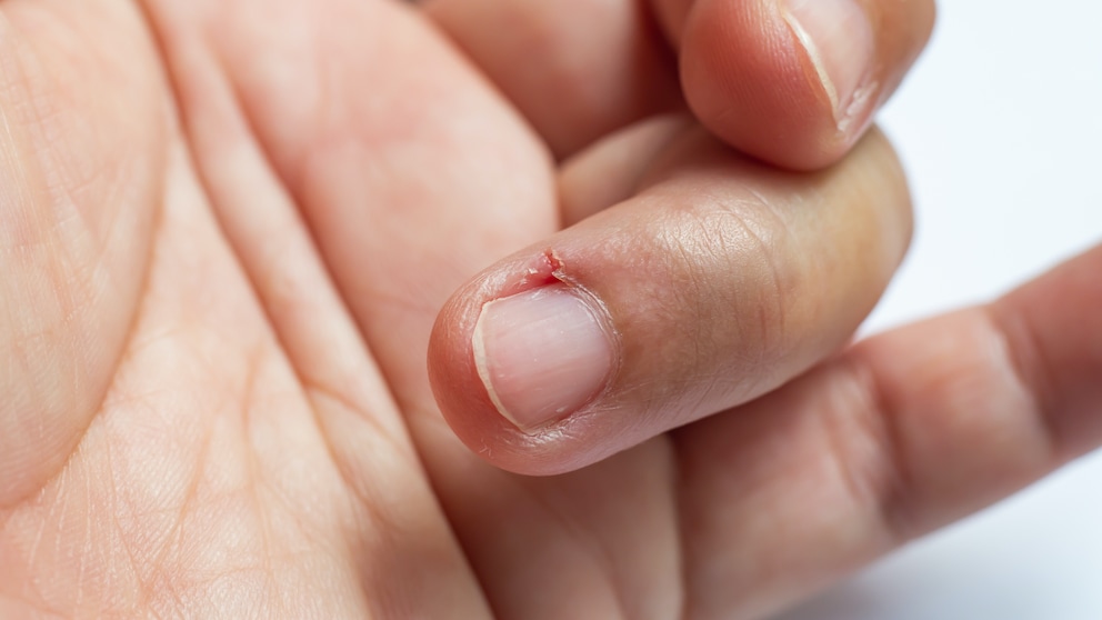 Hand im Close-up mit Nietnagel