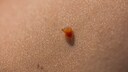 Nahaufnahme vom Fibrom