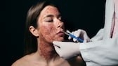 Frau bekommt Injektionen ins Gesicht