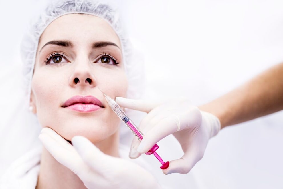Nasolabial folds can be injected with hyaluronic acid