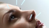 Was steckt hinter kosmetischer Akupunktur?