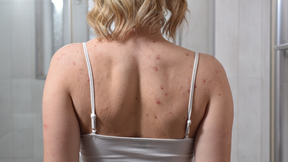 Pickel an Rücken und Schultern sind ein verbreitetes Problem – doch es gibt Lösungen