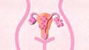 In den Eierstöcken können sich Zysten bilden. Manchmal bleiben sie unentdeckt, andere Male können sie Schmerzen verursachen