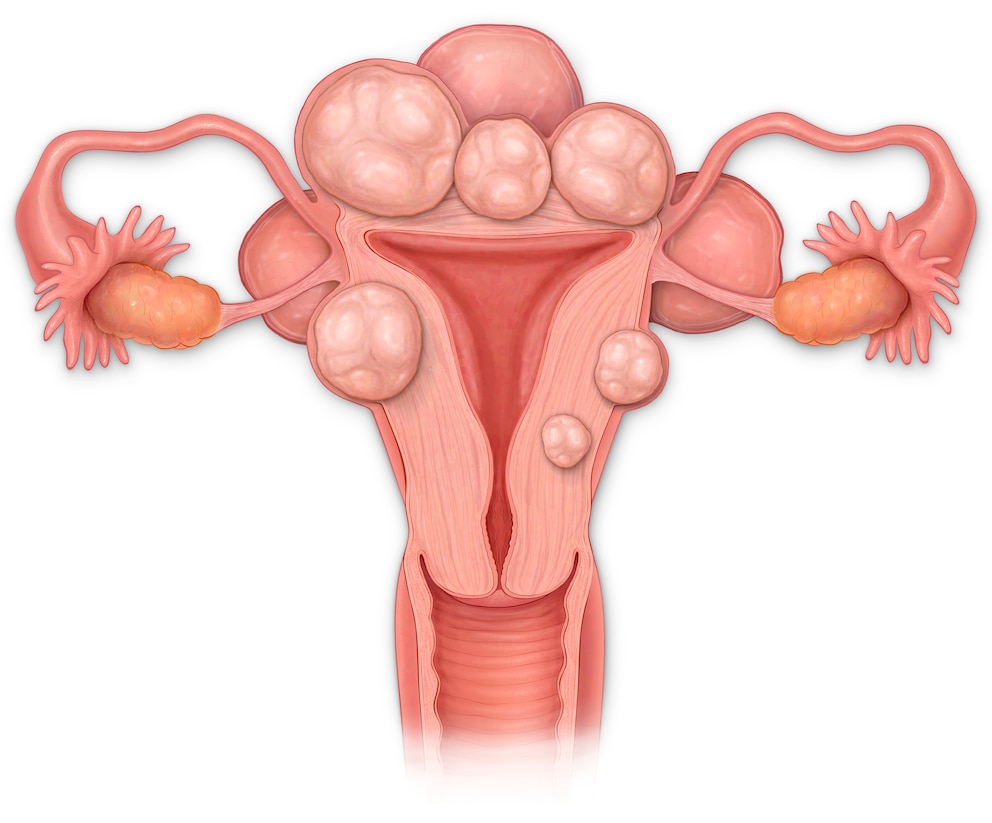 Ob man ein Myom behandeln muss, ist von seiner Größe und Lage im Uterus abhängig