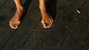 Der Hallux valgus betrifft häufig Frauen
