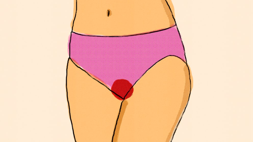 Ein kleines Schwämmchen soll Menstruationsblut aufhalten – was Soft Tampons können und was nicht, lesen Sie hier