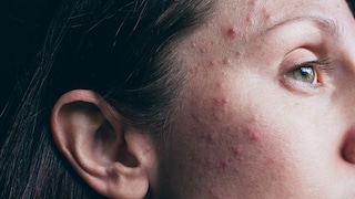 Woman with acne skin problem with hormonal acne, closeup. Hormonal acne, adult acne face before photo. Matching after photo with clear skin, retouched skin, available.