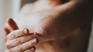 Male rubbing moisturising lotion on dry elbows and arm. Space for copy.