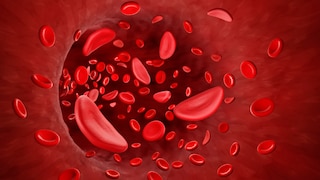 Illustration of sickle cells in blood flow.