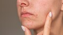 Sie geben viel Geld für Pflege aus, doch ihre Haut reagiert gereizt? Dann könnten Sie unter perioraler Dermatitis leiden!