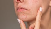 Sie geben viel Geld für Pflege aus, doch ihre Haut reagiert gereizt? Dann könnten Sie unter perioraler Dermatitis leiden!