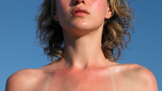 Sonnenbrand