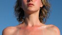 Sonnenbrand