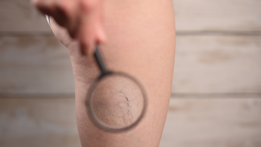 Sind Besenreiser ein ästhetisches Problem oder Gesundheitsrisiko? STYLEBOOK erklärt’s.
