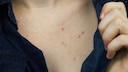Wie bleibt die Haut am Dekolleté rein? STYLEBOOK fragte beim Dermatologen nach.