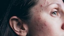 Hormonelle Akne kann im Erwachsenenalter auch psychisch ziemlich belastend sein