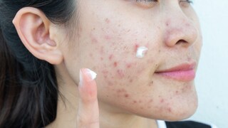 Frau mit Pickel im Gesicht und Creme
