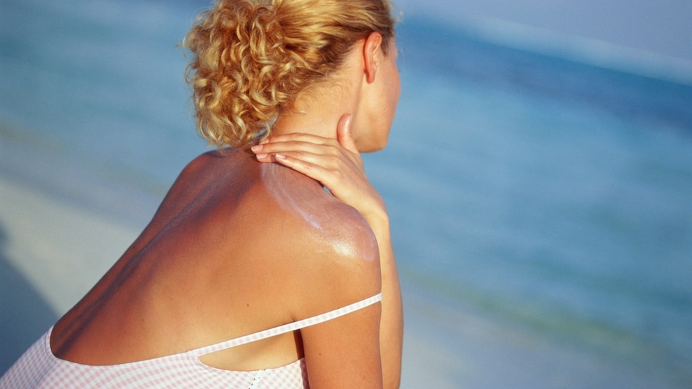Sonnenbrand