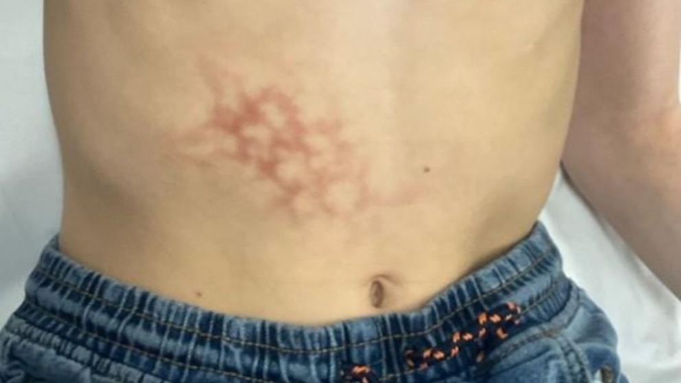 Netzartige Hautver&auml;nderungen am Bauch bei der ersten Untersuchung