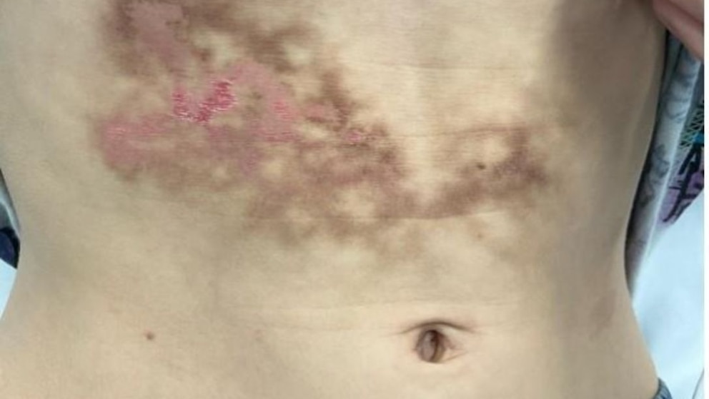 Netzartige Hautver&auml;nderungen am Bauch bei der zweiten Untersuchung