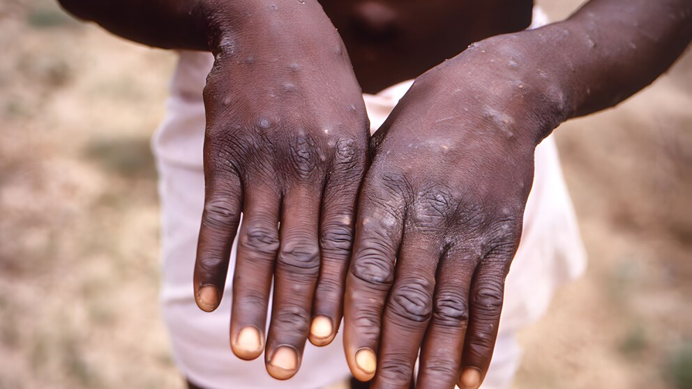 Hände eines an Mpox erkrankten Patienten